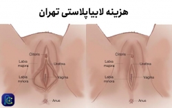 هزینه لابیاپلاستی تهران | مجله سلامت یاثار