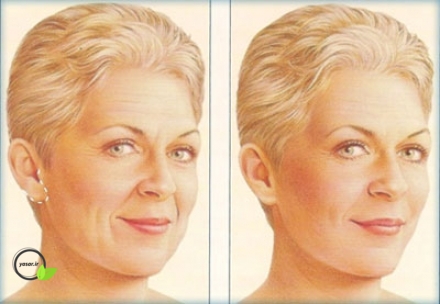 آشنایی با مراحل انجام عمل جراحی لیفت صورت و گردن