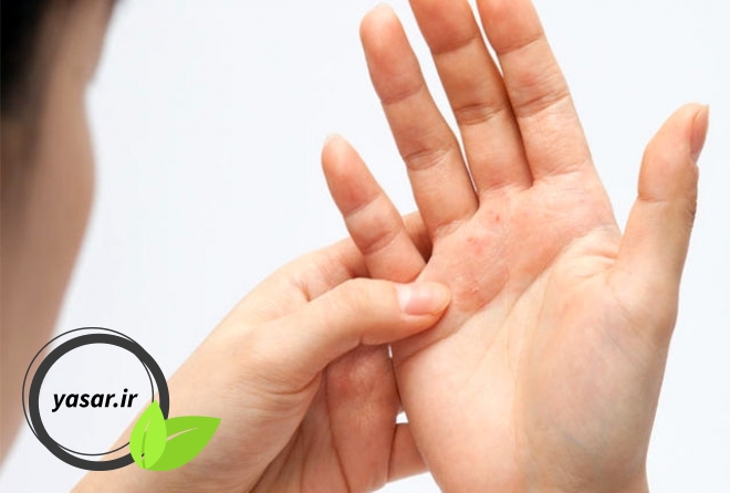 آیا خارش پوست هم ممکن است نوعی بیماری باشد؟