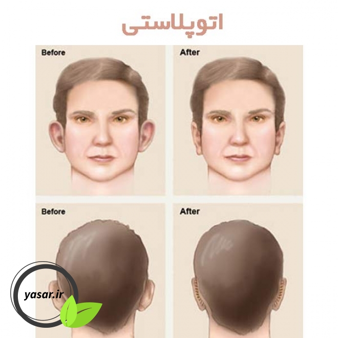 اتوپلاستی چگونه انجام خواهد شد؟