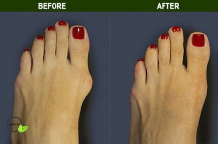 بونیون چیست و چه روش درمانی دارد