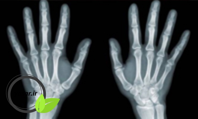 بیماری سرطان استخوان در افراد چگونه تشخیص داده می شود؟