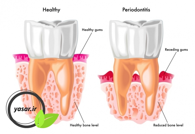 بیماری پریودنتیت چیست و چرا دندان ها را خراب می کند؟