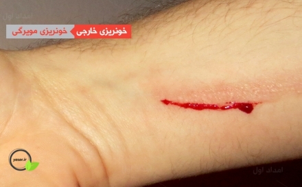حداقل اطلاعاتی که در زمان خونریزی باید بدانیم
