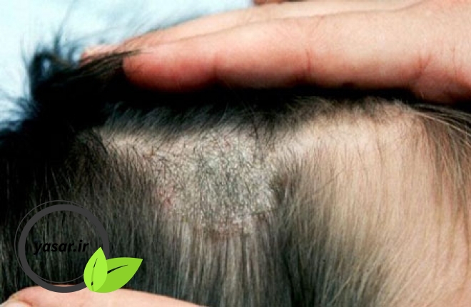 روش های پیشگیری از قارچ سر