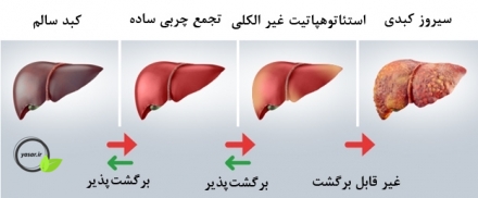 سریعترین راه درمان کبد چرب