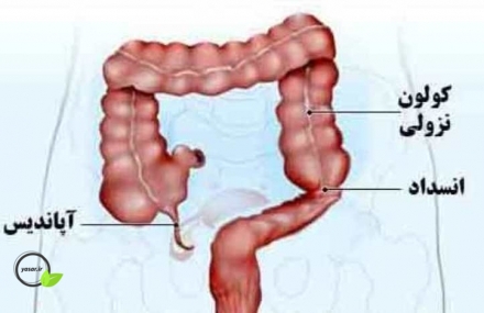 عفونت در آپاندیس چه علائمی به همراه دارد؟