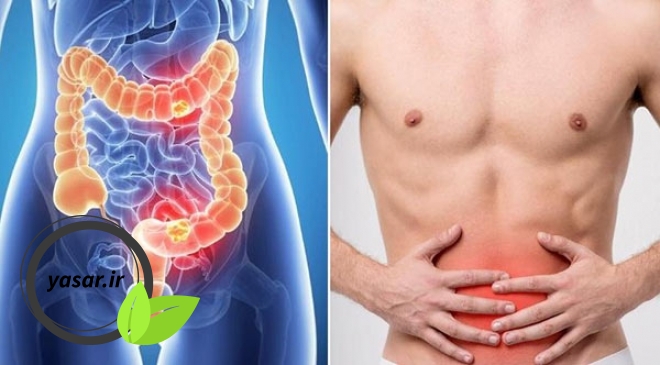 علل کاهش سن در بیماری سرطان گوارش