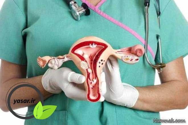 فریز دهانه رحم راه حلی برای برطرف کننده مشکلات داخلی آن