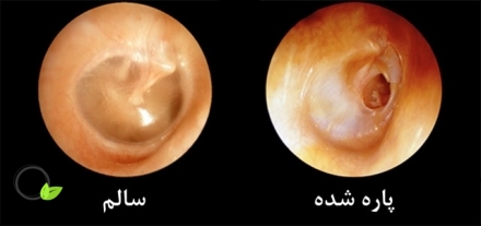 پارگی پرده گوش